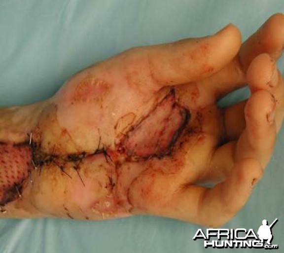 Puff Adder Bite