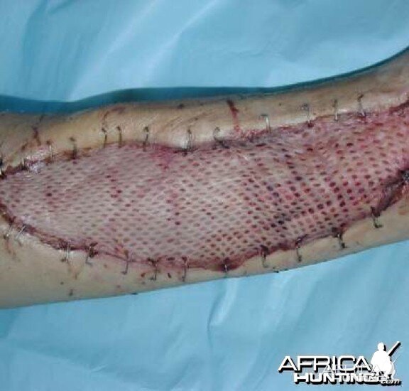 Puff Adder Bite