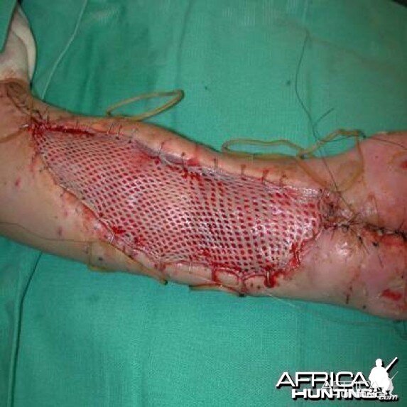 Puff Adder Bite