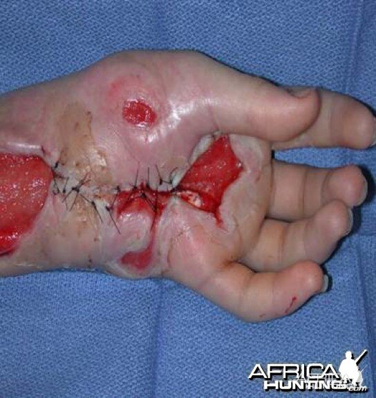 Puff Adder Bite