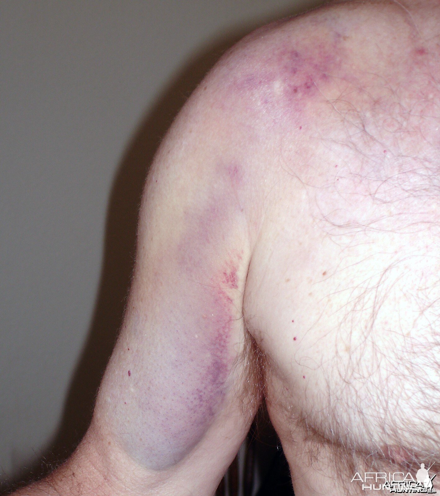 bruise on shoulder